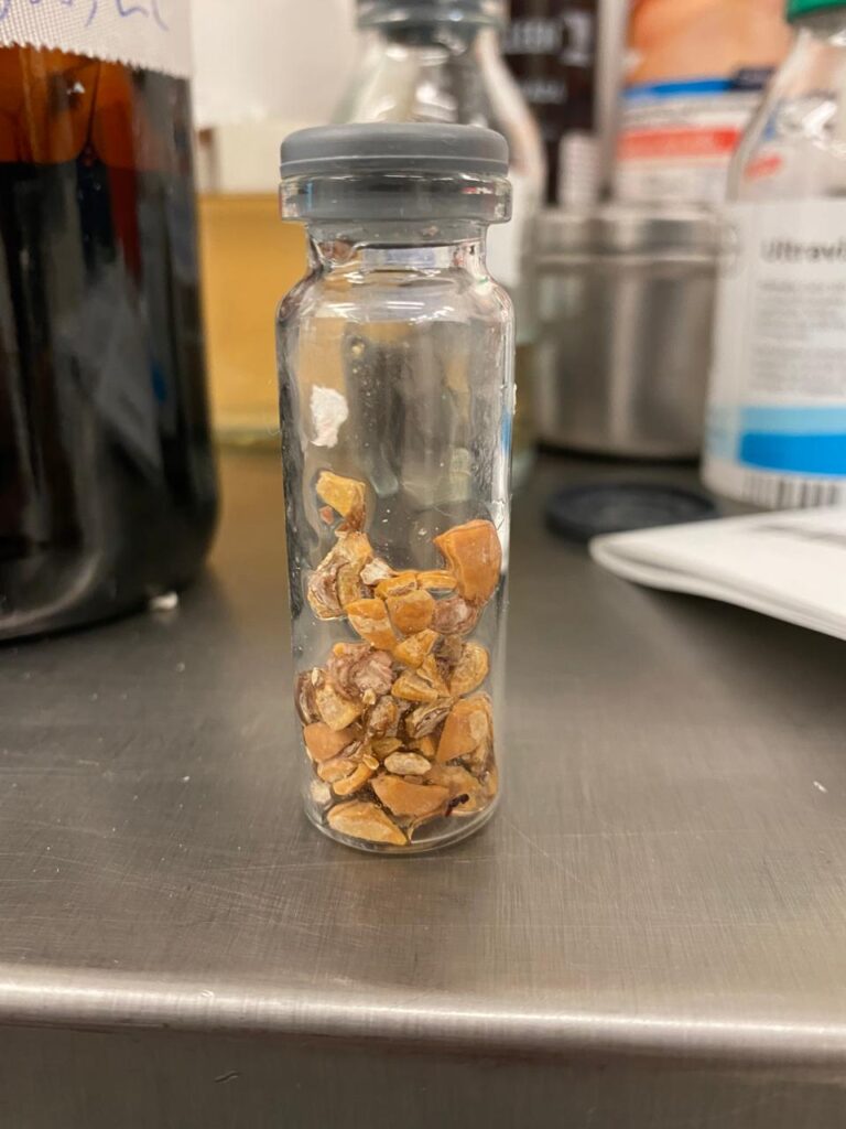 Kidney Stones Symptoms