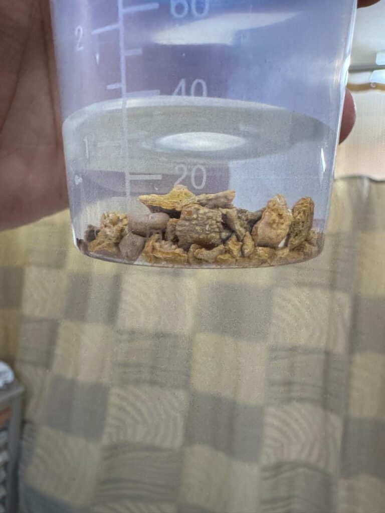 Stones removed from kidney after PCNL procedure by Dr. Freddy Urroz, Urologist in Belize