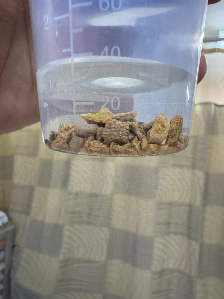 Stones removed from kidney after PCNL procedure by Dr. Freddy Urroz, Urologist in Belize